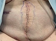 After Image: Massive 19 cm wide hernia repaired with preoperative Botox, anterior components release, and Duramesh - front