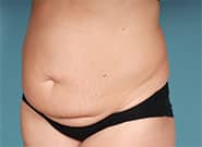 Before Image: Abdominoplasty with Duramesh - front