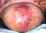 Before Image: Massive 19 cm wide hernia repaired with preoperative Botox, anterior components release, and Duramesh - front