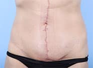 After Image: Abdominoplasty with Duramesh - front