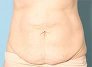 Before Image: Abdominoplasty with Duramesh - front
