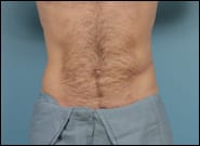 After Image: Flank Hernia Repair - front