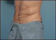 After Image: Flank Hernia Repair - left-front-oblique