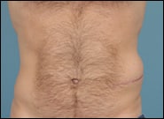 Before Image: Flank Hernia Repair - front