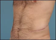 Before Image: Flank Hernia Repair - left-front-oblique