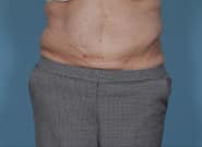 After Image: Flank Hernia Repair - front