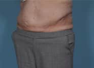 After Image: Flank Hernia Repair - left-front-oblique