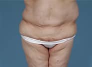 Before Image: Flank Hernia Repair - front