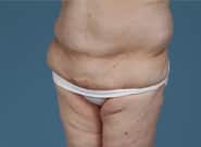 Before Image: Flank Hernia Repair - left-front-oblique