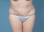 After Image: Flank Hernia Repair - front