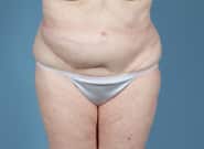 Before Image: Flank Hernia Repair - front