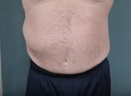 After Image: Flank Hernia Repair - front