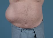 Before Image: Flank Hernia Repair - front