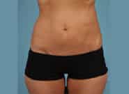 After Image: Flank Hernia Repair - front