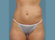Before Image: Flank Hernia Repair - front
