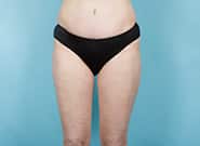 After Image: Liposuction - front