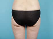 After Image: Liposuction - back