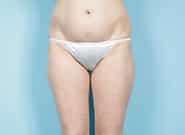 Before Image: Liposuction - front