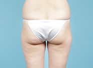 Before Image: Liposuction - back