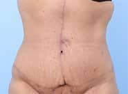 After Image: Mesh Abdominoplasty - front