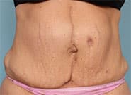 Before Image: Mesh Abdominoplasty - front