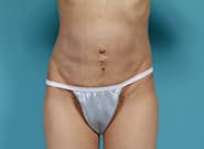 After Image: Mesh Abdominoplasty - front