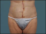 After Image: Mesh Abdominoplasty - front