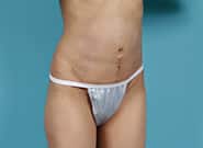 After Image: Mesh Abdominoplasty - right-front-oblique