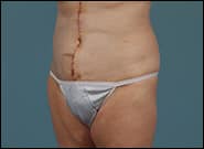 After Image: Mesh Abdominoplasty - left-front-oblique