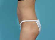 After Image: Mesh Abdominoplasty - left-side