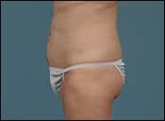 After Image: Mesh Abdominoplasty - left-side