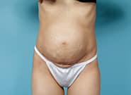 Before Image: Mesh Abdominoplasty - front