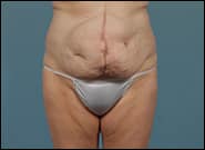 Before Image: Mesh Abdominoplasty - front