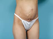 Before Image: Mesh Abdominoplasty - right-front-oblique