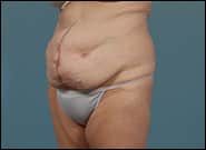 Before Image: Mesh Abdominoplasty - left-front-oblique
