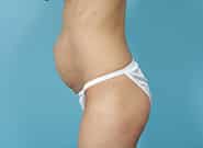 Before Image: Mesh Abdominoplasty - left-side