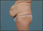 Before Image: Mesh Abdominoplasty - left-side