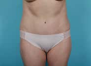 After Image: Mesh Abdominoplasty - front
