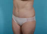 After Image: Mesh Abdominoplasty - left-front-oblique