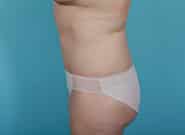 After Image: Mesh Abdominoplasty - left-side