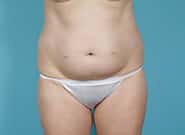 Before Image: Mesh Abdominoplasty - front
