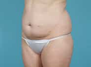 Before Image: Mesh Abdominoplasty - left-front-oblique