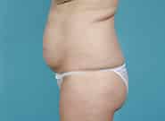 Before Image: Mesh Abdominoplasty - left-side