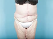 After Image: Mesh Abdominoplasty - front