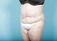 After Image: Mesh Abdominoplasty - left-front-oblique