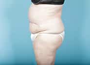 After Image: Mesh Abdominoplasty - left-side
