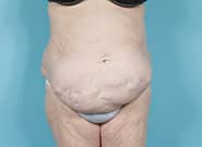 Before Image: Mesh Abdominoplasty - front