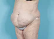 Before Image: Mesh Abdominoplasty - left-front-oblique