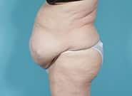 Before Image: Mesh Abdominoplasty - left-side