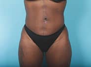 After Image: Mesh Abdominoplasty - front
